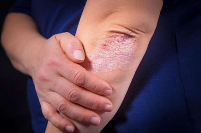 psoriasis derma